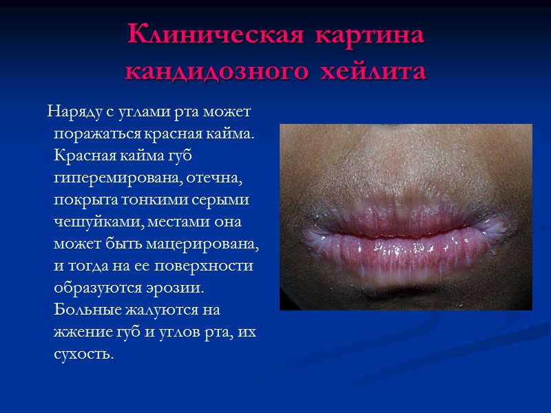 Клиническая картина кандидозного хейлита    Наряду с углами рта может поражаться красная